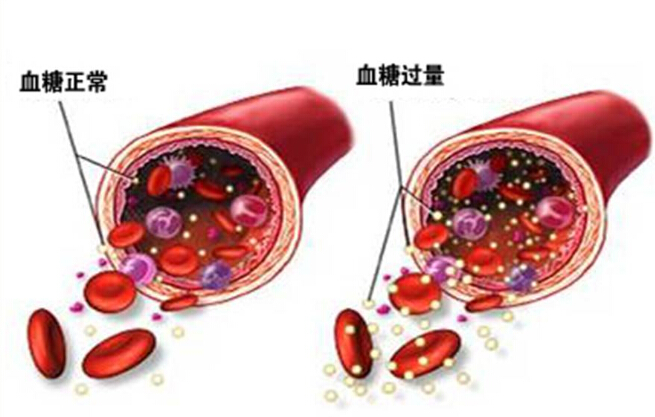 糖代谢紊乱的临床表现